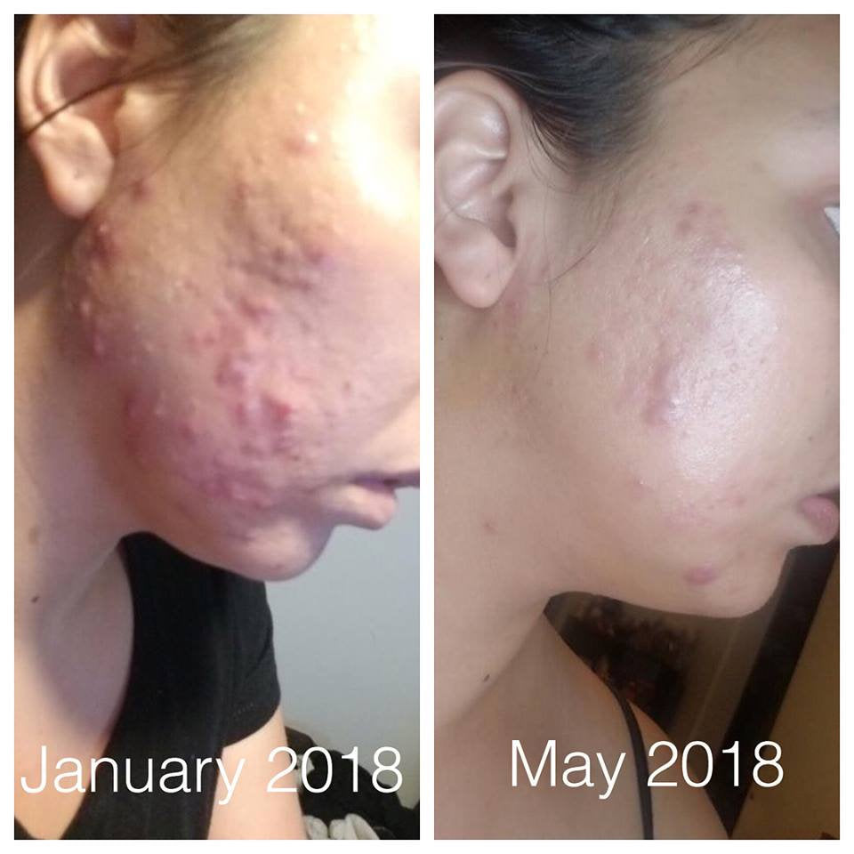 Super Acne Fighter / Organic Acne Treatment / Acne / Essential Oils / Natural  Acne Treatment / Acne Scars / Hormonal Acne / Cystic Acne