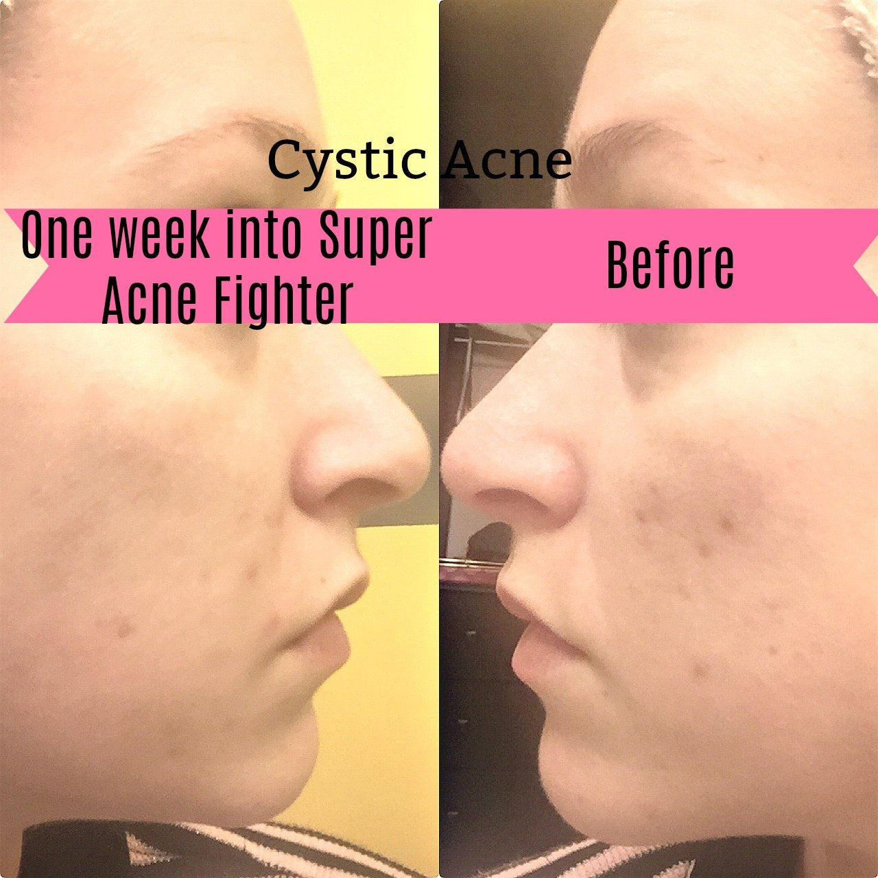 Super Acne Fighter / Organic Acne Treatment / Acne / Essential Oils / Natural  Acne Treatment / Acne Scars / Hormonal Acne / Cystic Acne