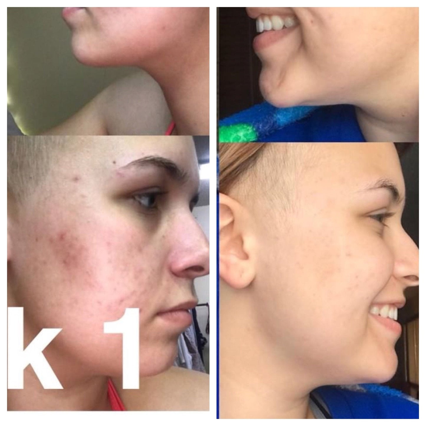 Super Acne Fighter / Organic Acne Treatment / Acne / Essential Oils / Natural  Acne Treatment / Acne Scars / Hormonal Acne / Cystic Acne